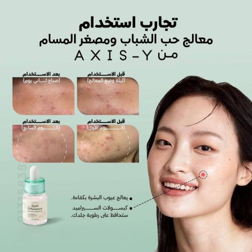 اقوا علاج ل حب الشباب 