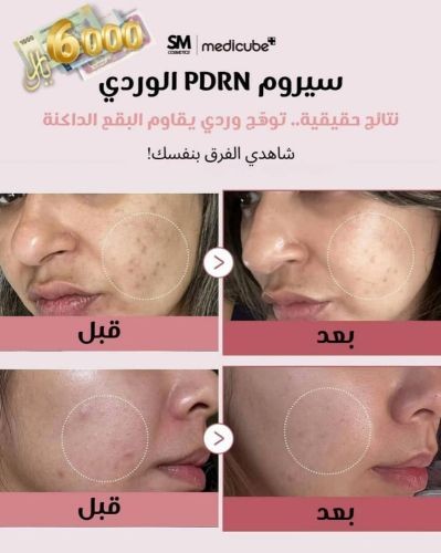 سيروم يعزز التفتيح البشرة والعيوب